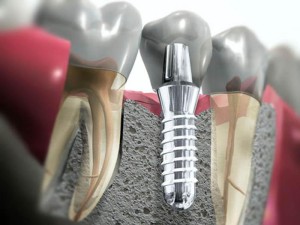 Дентальная имплантация зубов.