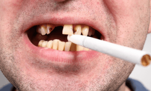 Влияние курения на здоровье зубов