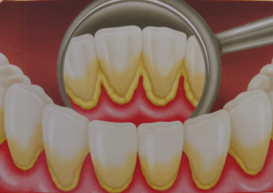 Зубной налет