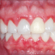 Лечение гингивита в стоматологии Реутова