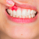 Лечение десен в стоматологии Реутова