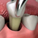 Удаление зуба Реутов