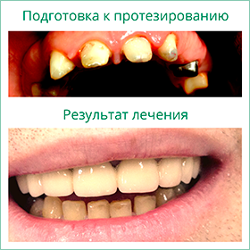 Импланты зубов Реутов Примеры работ