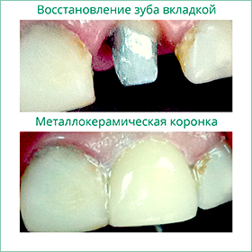 Имплантация зубов Примеры работ