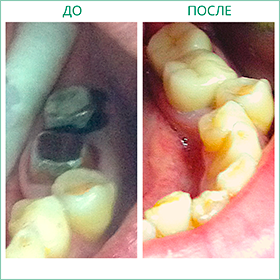 Импланты зубов Примеры работ