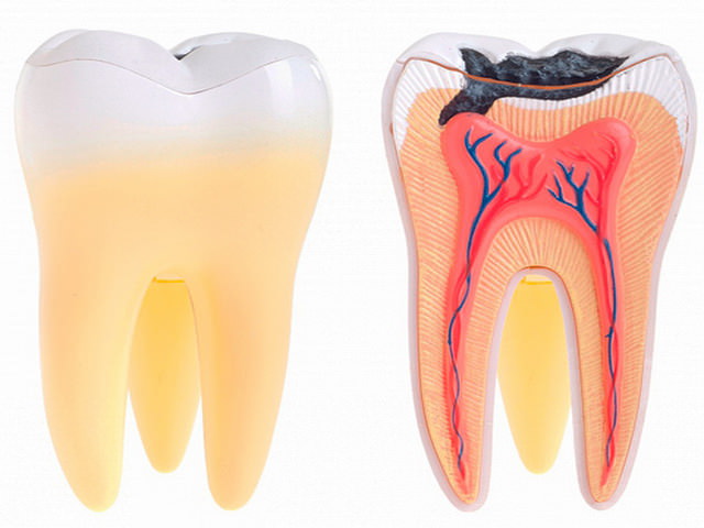 Лечение кисты зуба. Киста на зубе лечение или удаление