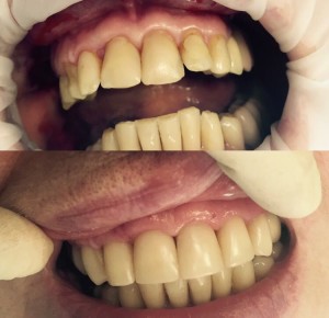 реставрация зубов в Реутове