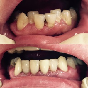 восстановление зуба в Реутове