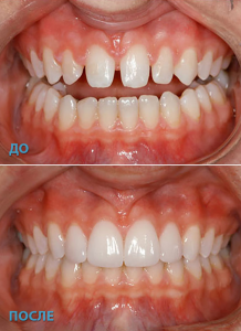 пример работы выполненной в стоматологической клинике Реутова Профи-Дент