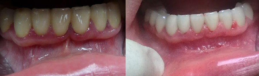 Удаление зуба, операции на деснах в Реутове